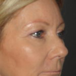 Blepharoplasty Arizona Before Photos Case 5