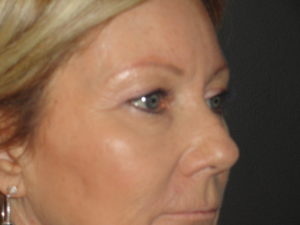 Blepharoplasty Arizona Before Photos Case 5