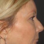 Blepharoplasty Arizona Before Photos Case 5