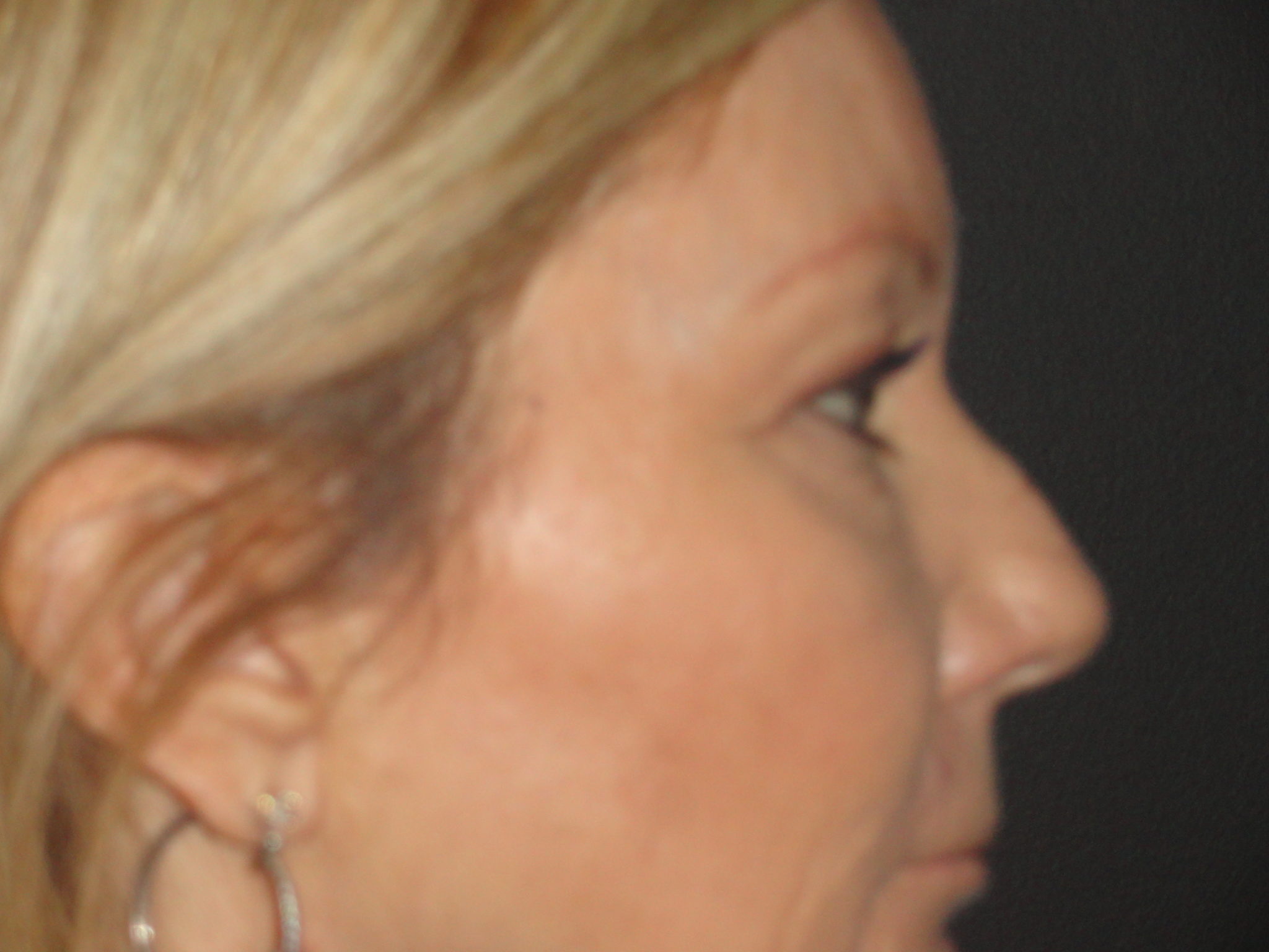 Blepharoplasty Arizona Before Photos Case 5