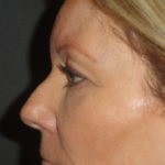 Blepharoplasty Arizona Before Photos Case 5