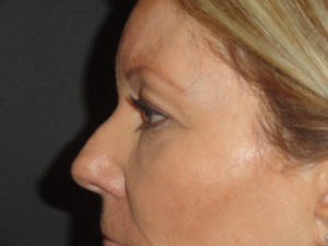 Blepharoplasty Arizona Before Photos Case 5