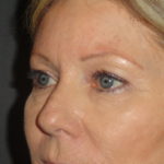 Blepharoplasty Arizona Before Photos Case 5