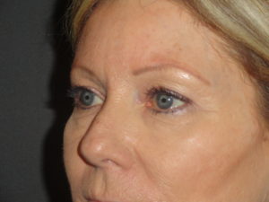 Blepharoplasty Arizona Before Photos Case 5