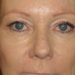 Blepharoplasty Arizona Before Photos Case 5