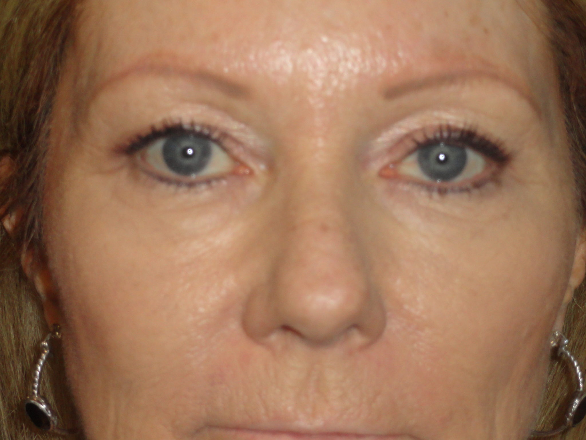 Blepharoplasty Arizona Before Photos Case 5