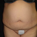 Body Lift Surgery in Phoenix Arizona Before Photos