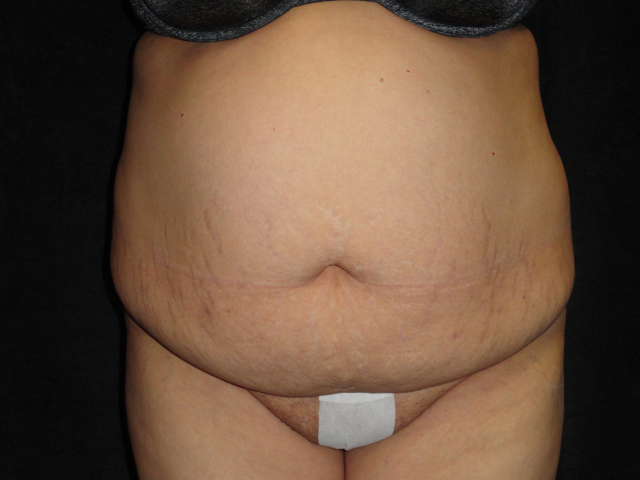 Body Lift Surgery in Phoenix Arizona Before Photos