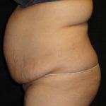 Body Lift Surgery in Phoenix Arizona Before Photos