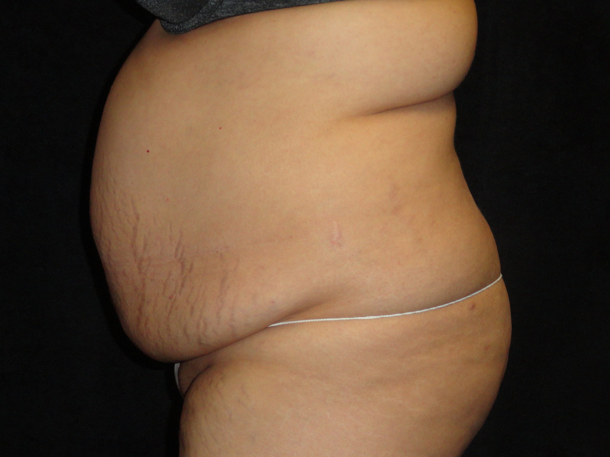 Body Lift Surgery in Phoenix Arizona Before Photos