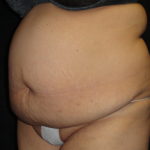 Body Lift Surgery in Phoenix Arizona Before Photos