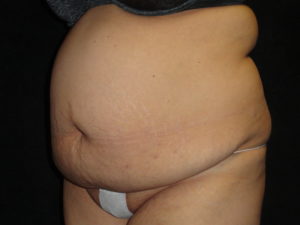 Body Lift Surgery in Phoenix Arizona Before Photos