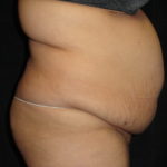 Body Lift Surgery in Phoenix Arizona Before Photos