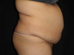 Body Lift Surgery in Phoenix Arizona Before Photos