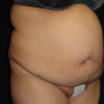 Body Lift Surgery in Phoenix Arizona Before Photos