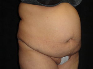 Body Lift Surgery in Phoenix Arizona Before Photos