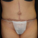 Body Lift Surgery in Phoenix Arizona After Photos