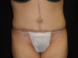 Body Lift Surgery in Phoenix Arizona After Photos