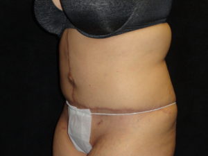 Body Lift Surgery in Phoenix Arizona After Photos