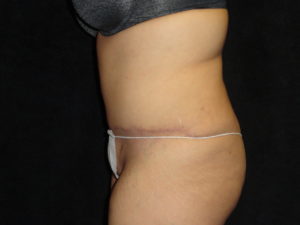 Body Lift Surgery in Phoenix Arizona After Photos