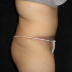 Body Lift Surgery in Phoenix Arizona After Photos