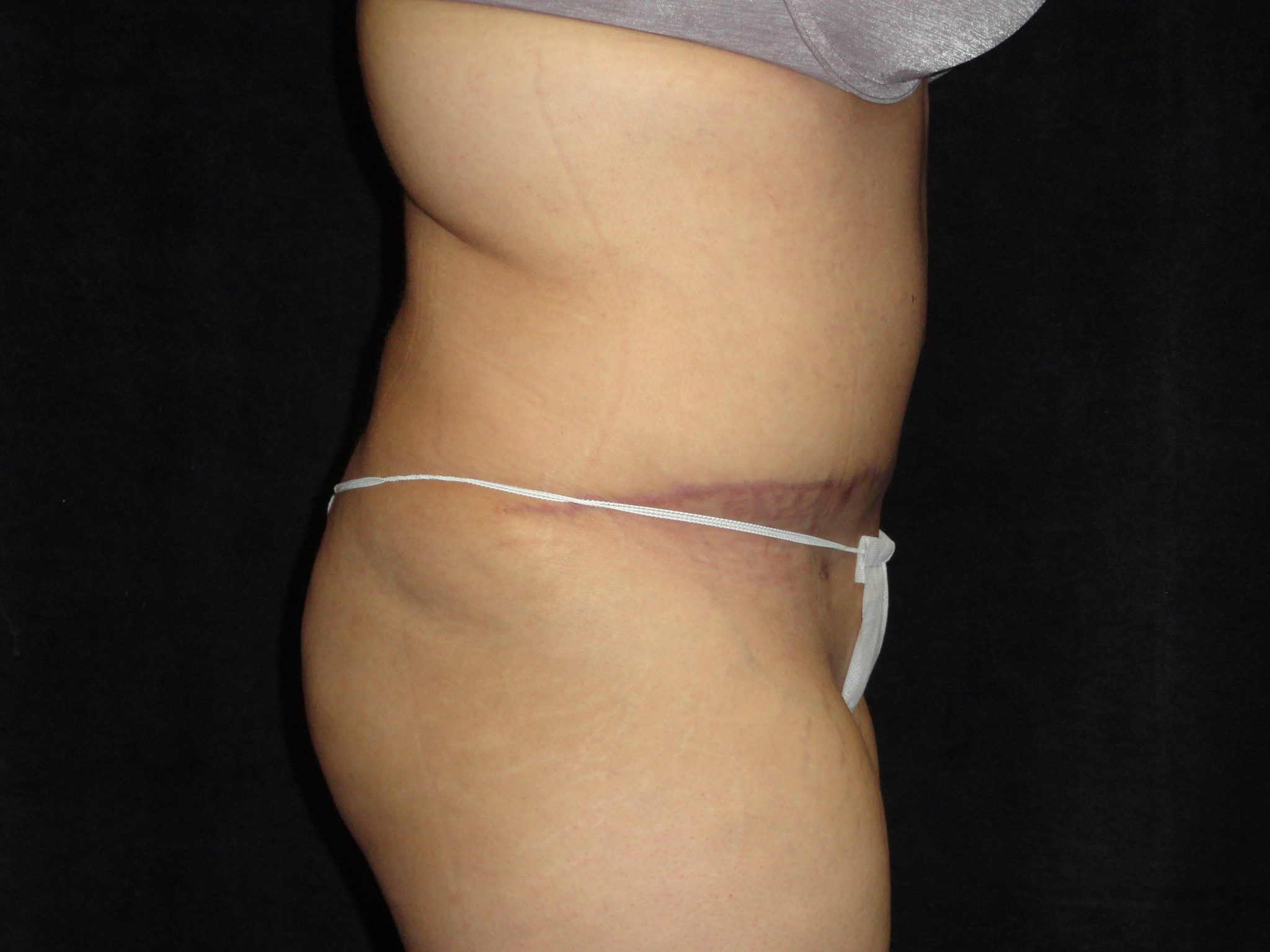 Body Lift Surgery in Phoenix Arizona After Photos