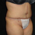 Body Lift Surgery in Phoenix Arizona After Photos