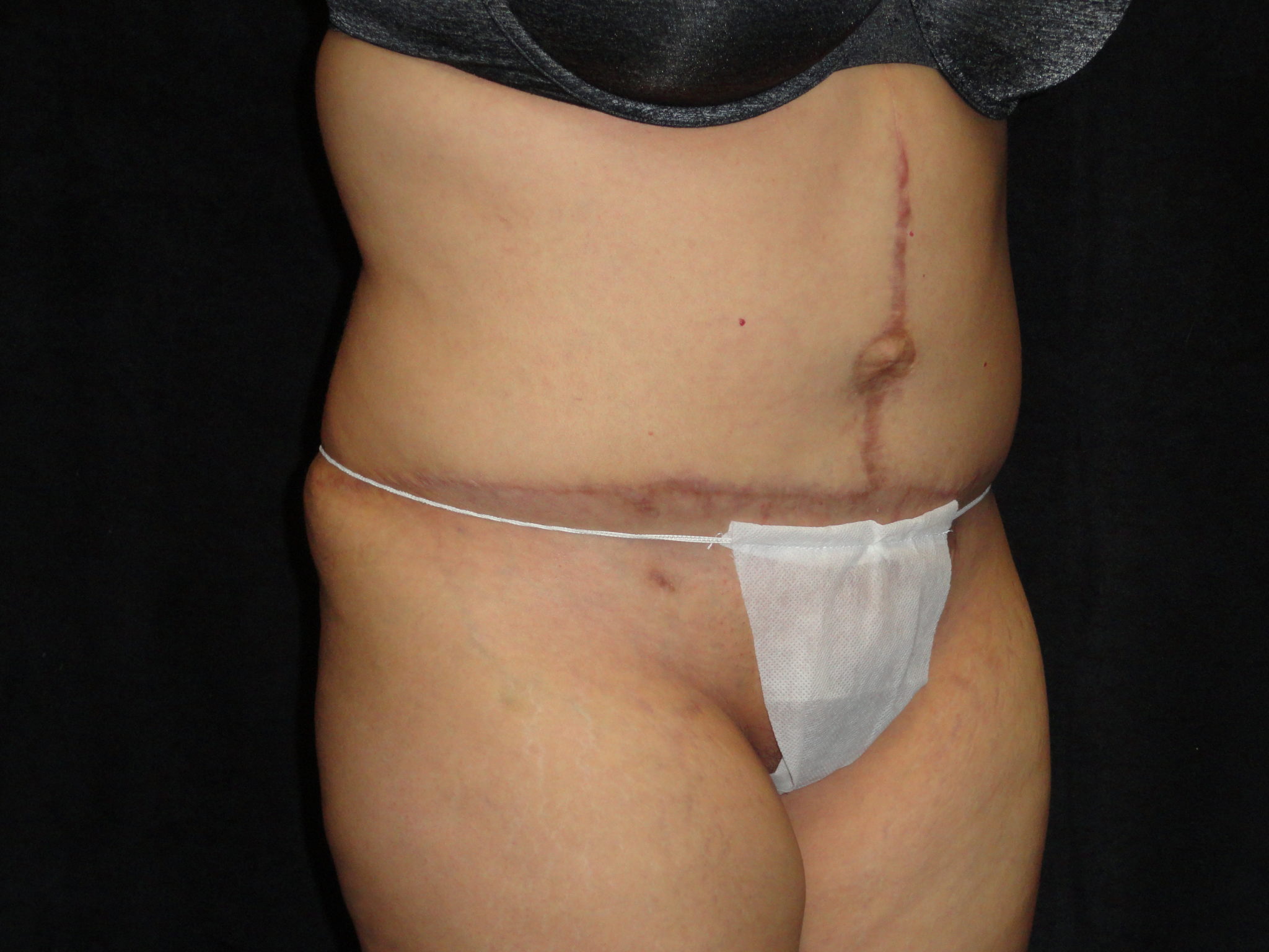 Body Lift Surgery in Phoenix Arizona After Photos