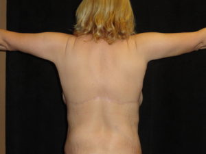 Body Lift Procedure in Arizona Before And After Photos