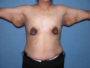 Scottsdale Arizona Brachioplasty Before Photos #2882