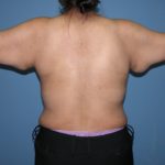 Scottsdale Arizona Brachioplasty Before Photos #2882