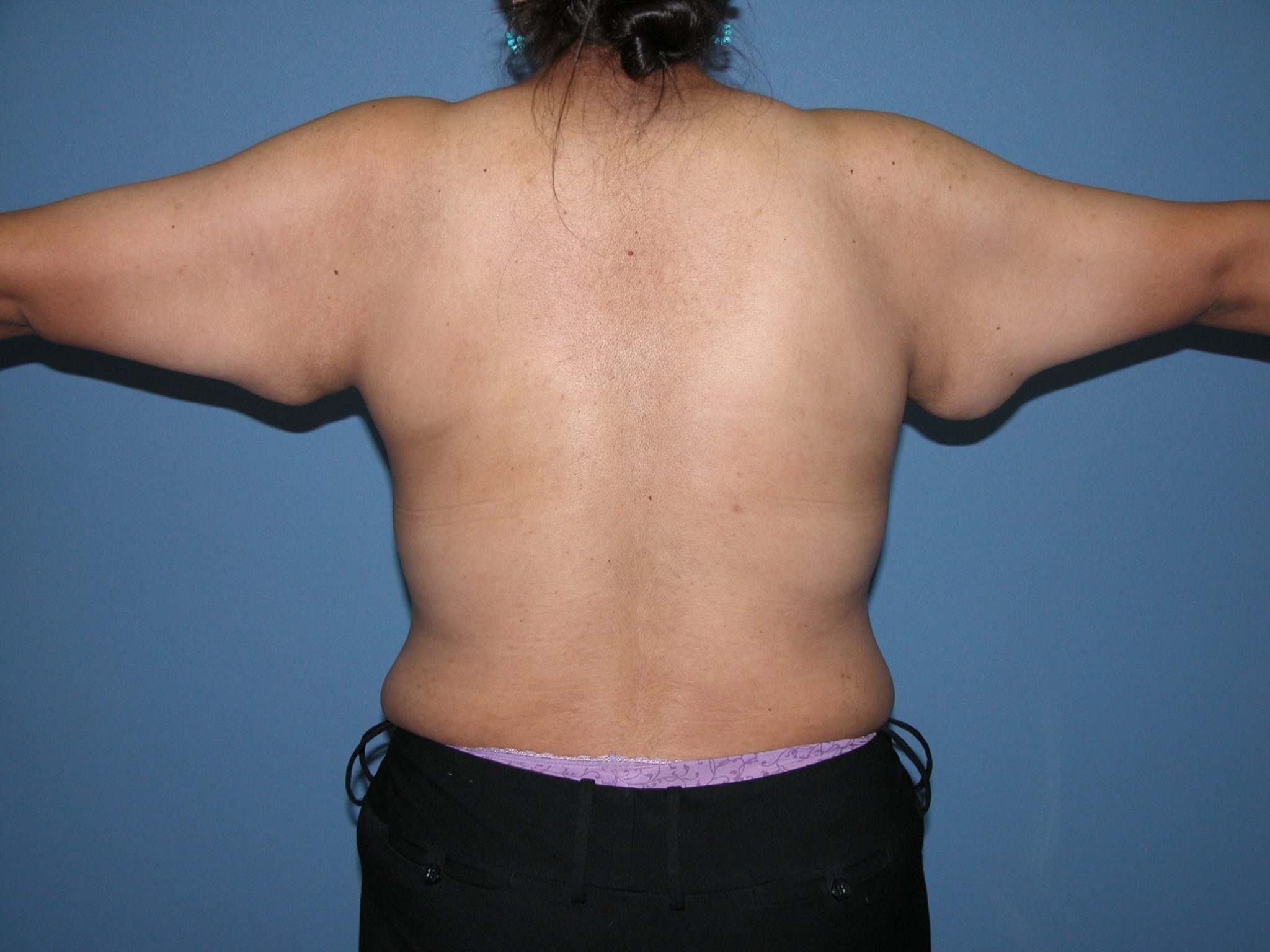 Scottsdale Arizona Brachioplasty Before Photos #2882