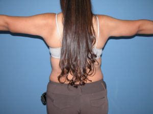 Scottsdale Arizona Brachioplasty After Photos #2882