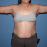 Scottsdale Arizona Brachioplasty After Photos #2882