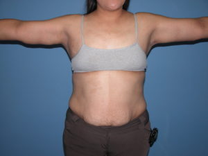 Scottsdale Arizona Brachioplasty After Photos #2882