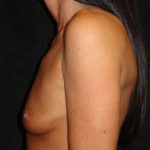 Breast Augmentation Before Photo #4552