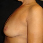 Breast Augmentation Scottsdale AZ Before Photos #4303