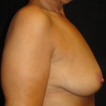 Breast Augmentation Scottsdale AZ Before Photos #4303