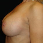 Breast Augmentation Scottsdale AZ After Photos #4303