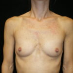 Phoenix Arizona Breast Augmentation #3887 Before Photos