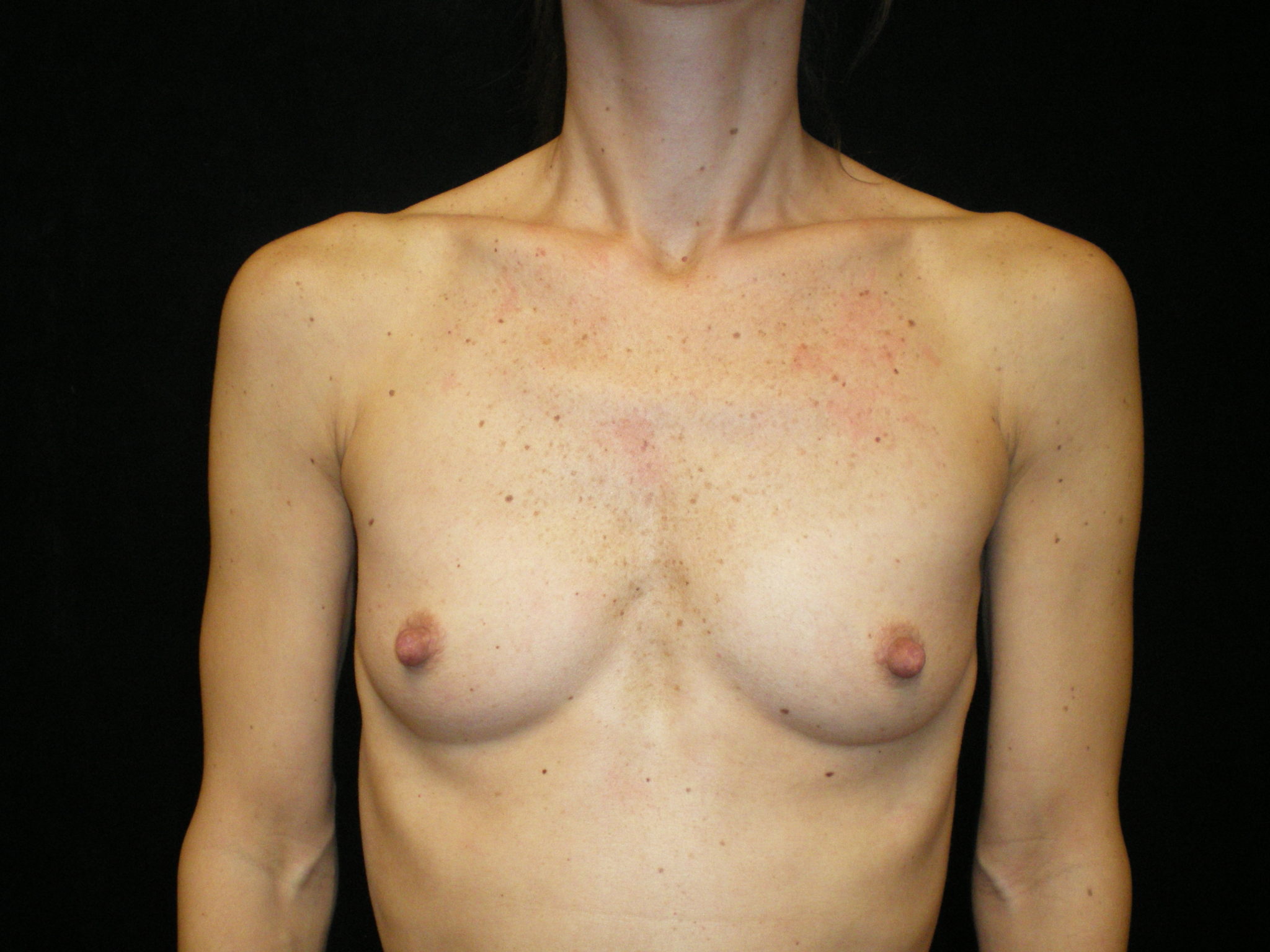 Phoenix Arizona Breast Augmentation #3887 Before Photos