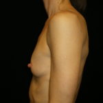 Phoenix Arizona Breast Augmentation #3887 Before Photos