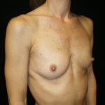 Phoenix Arizona Breast Augmentation #3887 Before Photos