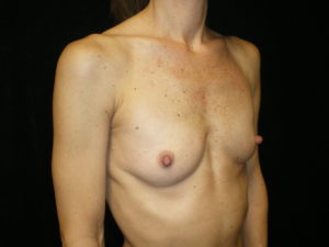 Phoenix Arizona Breast Augmentation #3887 Before Photos