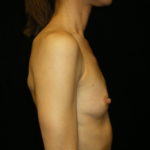 Phoenix Arizona Breast Augmentation #3887 Before Photos