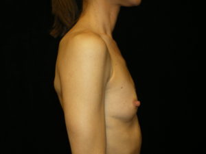 Phoenix Arizona Breast Augmentation #3887 Before Photos