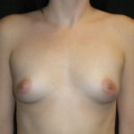 Best Scottsdale Breast Augmentation