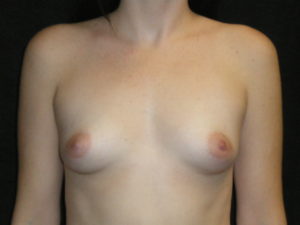 Best Scottsdale Breast Augmentation