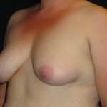 Breast Augmentation #4508 Scottsdale Before And After