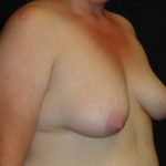 Breast Augmentation #4508 Scottsdale Before And After